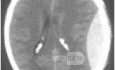 Epidural Hematom