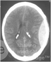Epidural Hematom