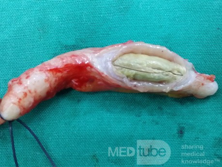 Acute Obstructive Appendicitis 