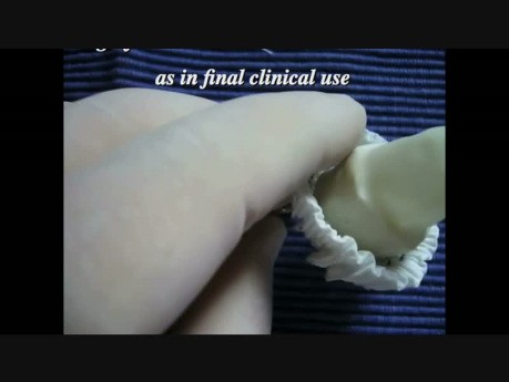 Expandable Dev. Type III For Easy, Reliable Approximation Of Dissection Layers In Aortic Anastomosis
