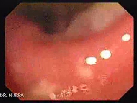 Colonic Tuberculosis Mimicking Crohn's Disease (1 of 12)