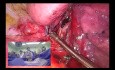 Unisurgeon VATS Uniportal Anatomic Segmentectomy (S2)