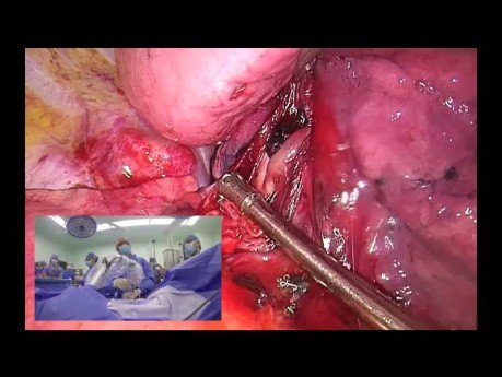 Unisurgeon VATS Uniportal Anatomic Segmentectomy (S2)