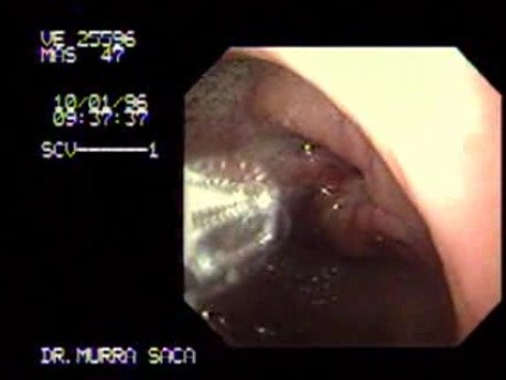 Gastric Adenocarcinoma - Obstruction 4