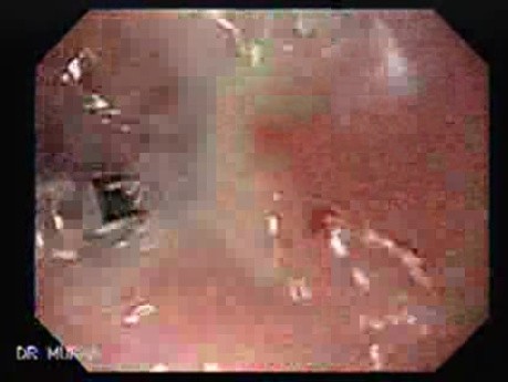 Post-irradiation Stenosis of the Esophagus - Visualization of the Tumor