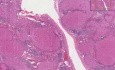 Liver - Cirrhosis 1