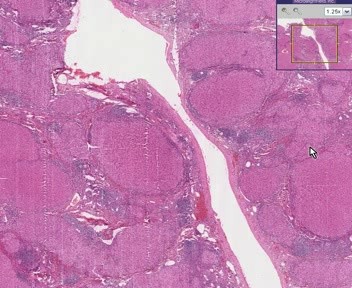 Liver - Cirrhosis 1
