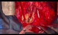 Redo Aortic Root Surgery 2 
