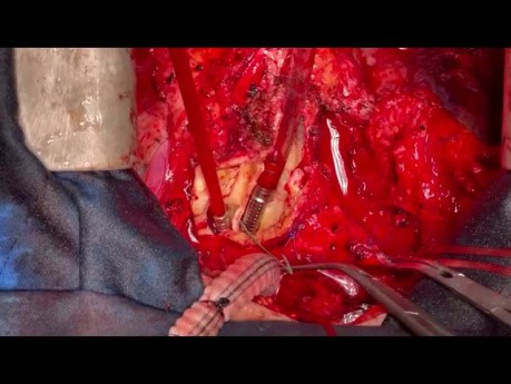Redo Aortic Root Surgery 2 