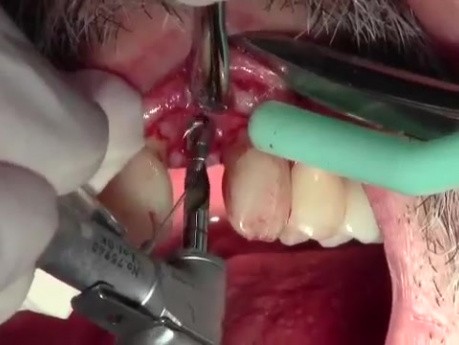 Klipod Recording Of Dental Implant Surgery - #10, Legac