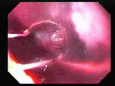 Hemorrhage After Ligation - Banding After Coagulation