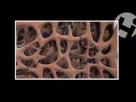 Effects of Accutane on Bone Strength