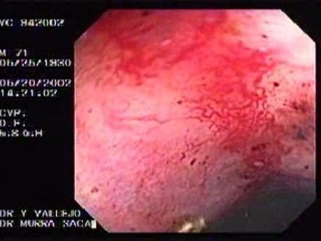Radiation Proctosigmoiditis (8 of 14)