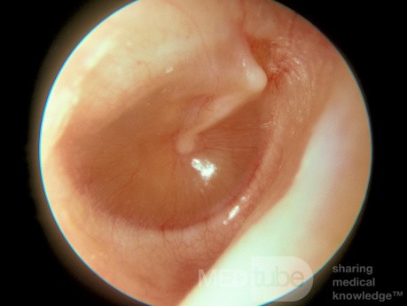 Mucoid Otitis Media