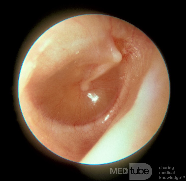 Mucoid Otitis Media