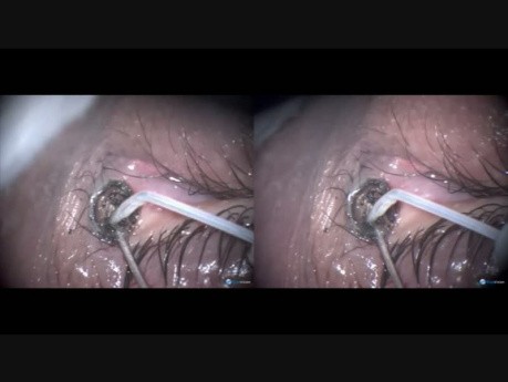 Naevus Over Canaliculus - Excision with Fugo Blade