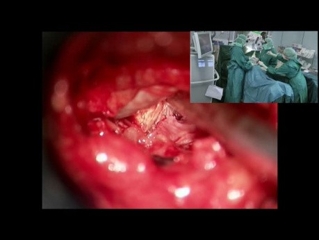 Lumbar Disc Herniation