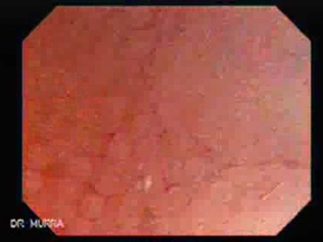 Terminal ileum (1 of 2)