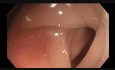 Colonoscopy - Sigmoid Colon EMR Scar