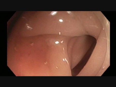 Colonoscopy - Sigmoid Colon EMR Scar