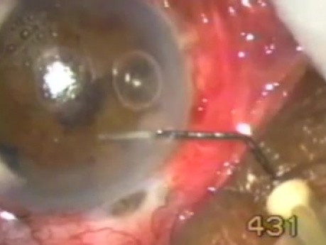 Dermoid of The Corneal Limbus - 1-Year-Old Child