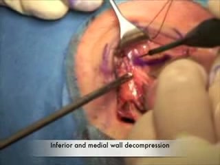 Three Wall Orbital Decompression For Thyroid Eye Disease