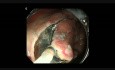 Hybrid ESD for early gastric cancer