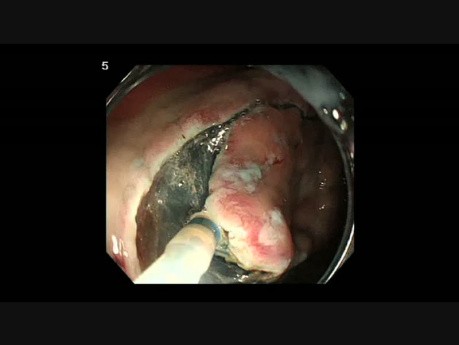 Hybrid ESD for early gastric cancer