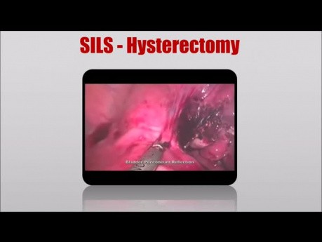 Single Incision Laparoscopic Surgery Lecture