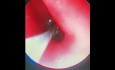 Endoscopic Removal of Loquat Pit