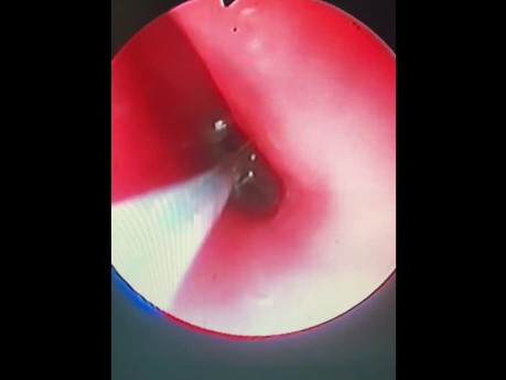 Endoscopic Removal of Loquat Pit