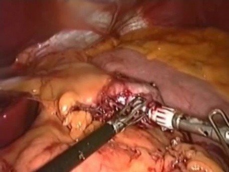 Gastric Bypass for Obesity Treatment