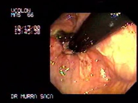 Status Post Rubber Band Ligation (3 of 3)