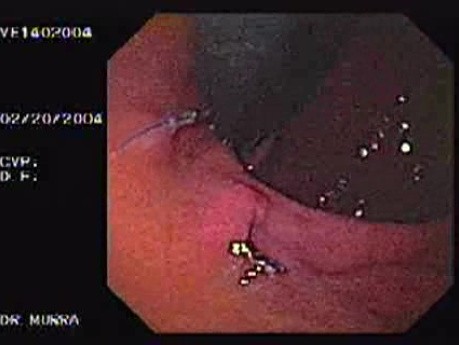 Intraluminal Endoscopic Suturing - Retroflexev View of Two Nodules, Part 2