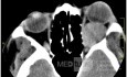 Total Resection of the Lesion Through a Lateral Fronto-Zygomatic Orbit Approach