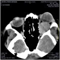 Total Resection of the Lesion Through a Lateral Fronto-Zygomatic Orbit Approach
