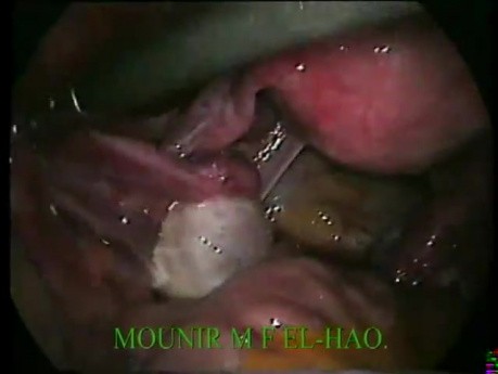 Hysteroscopy and Laparoscopy Performed for Diagnostic Purposes