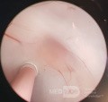 Endoscopic Third Ventriculostomy in a Benign Case of Aicardi Syndrome with Obstructive Hydrocephalus and Chiari Malformation type 1