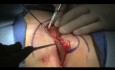 Bascom Cleft Lift Pilonidal Surgery Short Video