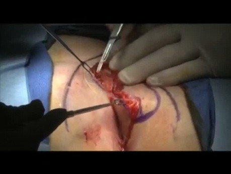 Bascom Cleft Lift Pilonidal Surgery Short Video