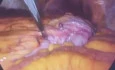 Extended Right Hemicolectomy in Transverse Colon Cancer by Laparoscopy