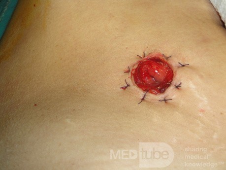 Multiple Rectal Ulcers (52 of 110)