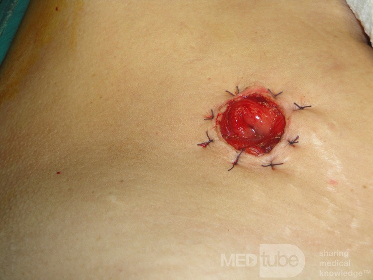 Multiple Rectal Ulcers (52 of 110)