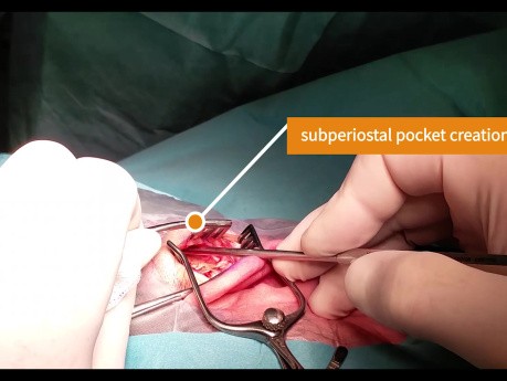 Minimally Invasive Pocket Technique for Attract Magnet Without Anchoring (Pr. P. Dolhen).