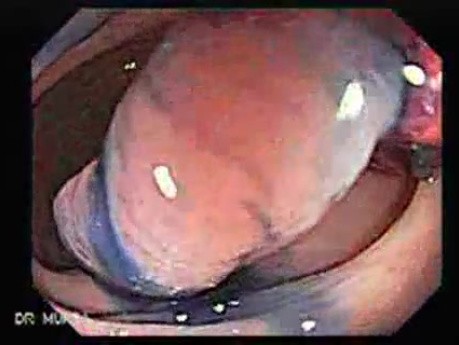 Colonoscopic Polypectomy (4 of 23)