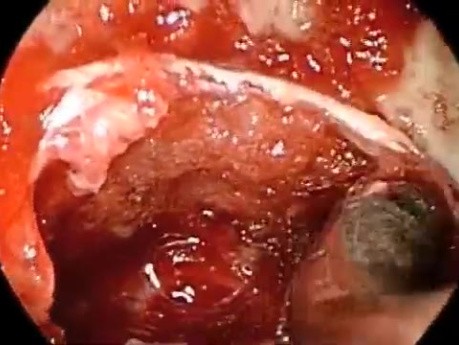 Endoscopic Removal of Pituitary Tumor Followed by Reconstruction
