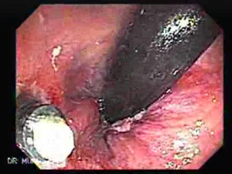Rubber Band Ligation of Hemorrhoids (2 of 3)