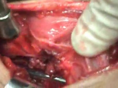 Perforation of a Esophageal Carcinoma after the procedure with hydrostatic balloon dilation (5 of 12)
