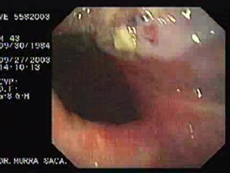 Acute Variceal Bleeding - Status Post Banding