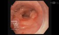 Colorectal Fistula Closure